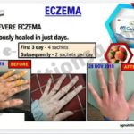Testimoni Ag Cera terhadap pesakit Ekzema